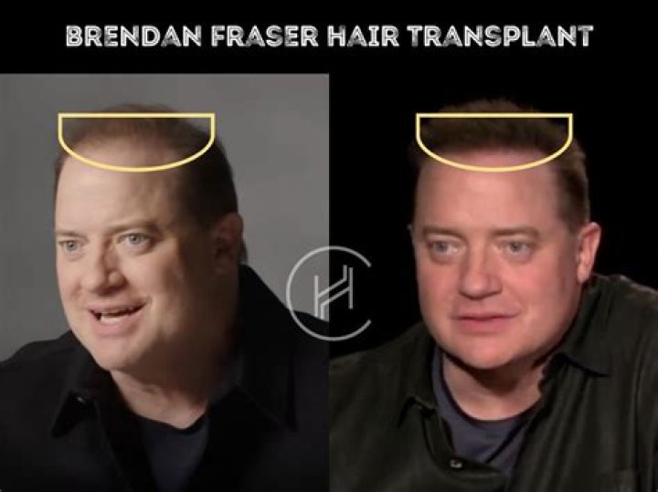 Brendan Fraser health: What illness did Brendan Fraser have? What surgeries did Brendan Fraser have?