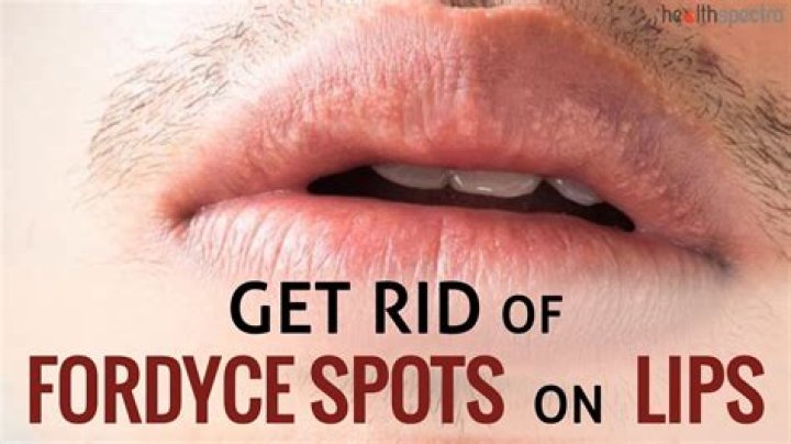 How to get rid of fordyce spots on lips