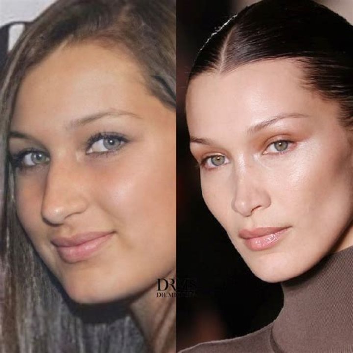 
What Did Bella Hadid Look Like Before Nose Job? Pre Plastic Surgery And Face Tape Photos Revealed! 