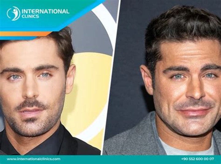 Zac Efron Plastic Surgery Video, Before & After Photos In 2022 – Has He Gotten Cosmetic Surgery?